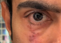 Abhishek Banerjee’s ‘scar’ post sparks political buzz amid US eye treatment