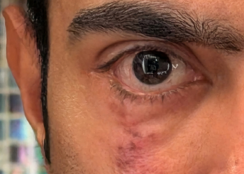Abhishek Banerjee’s ‘scar’ post sparks political buzz amid US eye treatment